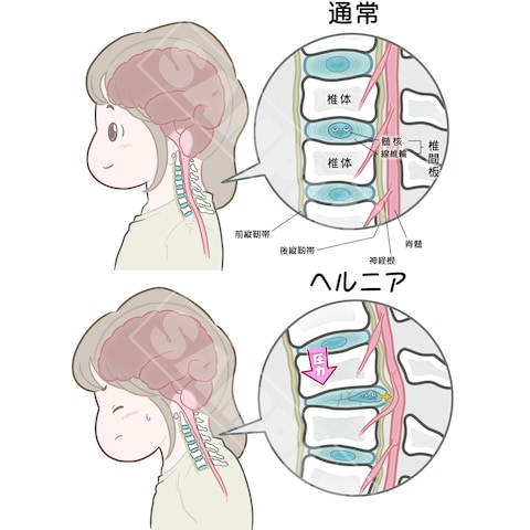 頚椎ヘルニアの病態説明図