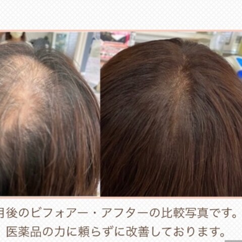 薄毛の窓口でのアドバイスによるビフォー・アフター