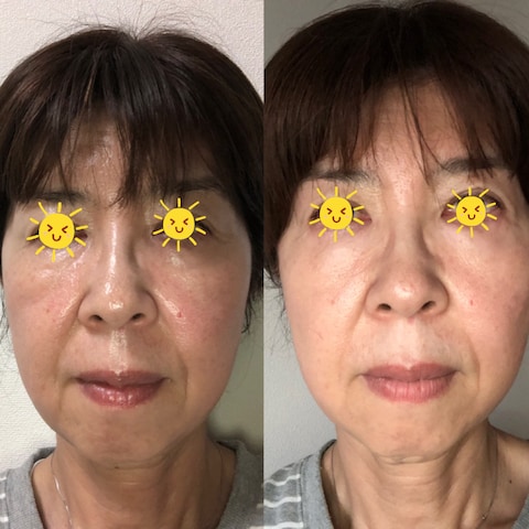 【モニター】ハリ感、引き締まり、肌のキメ・透明感アップ