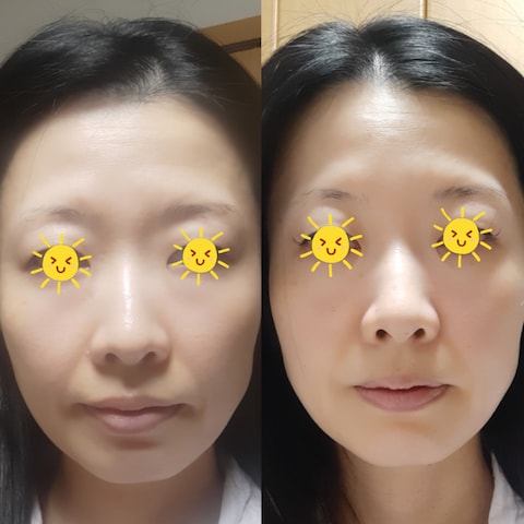 【モニター】フェイスラインが引きあがり透明感アップ