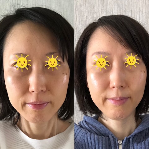 【モニター】頬のたるみやほうれい線・眉間のシワが改善