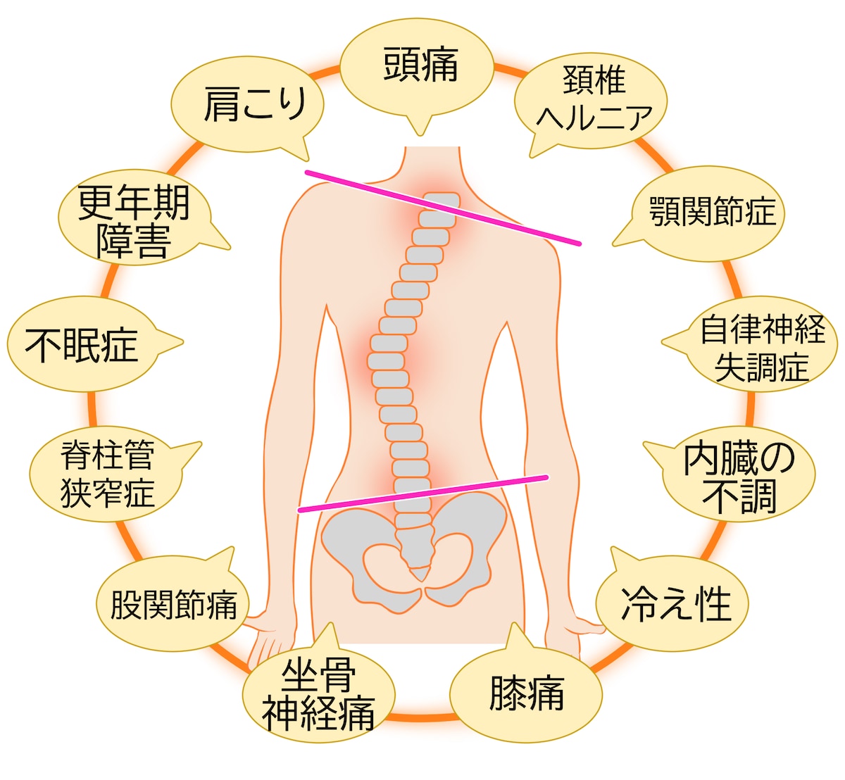 脊柱の歪みによる諸症状のイラスト