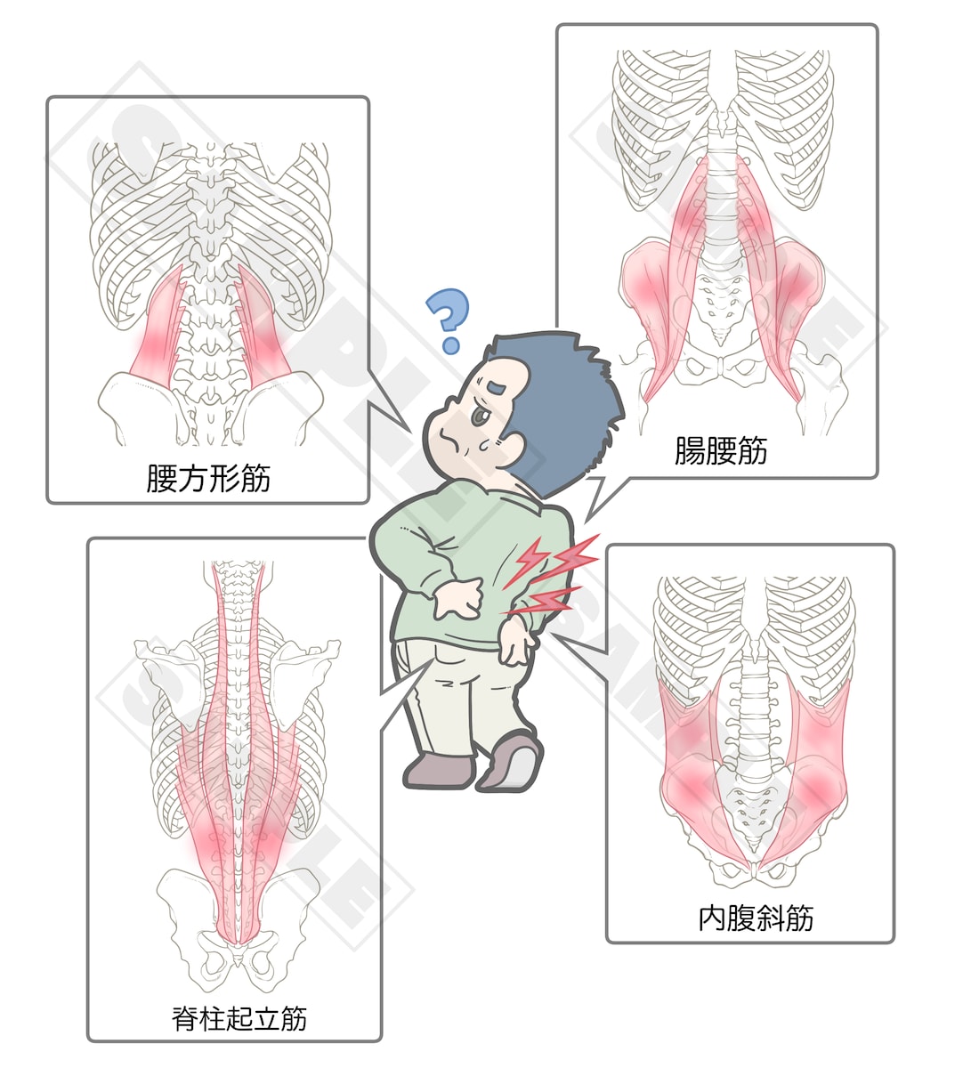 筋・筋膜性腰痛の例