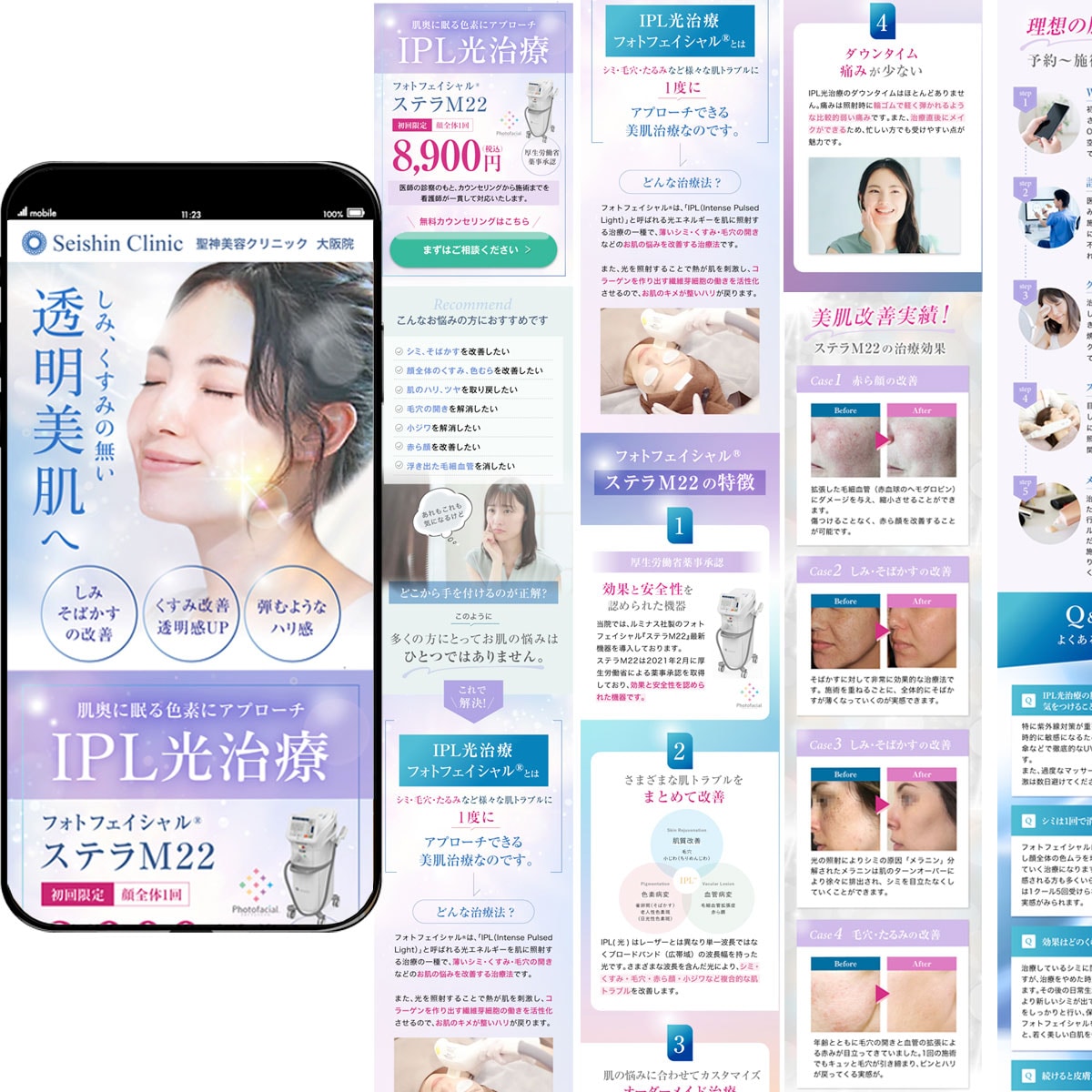 IPL光治療