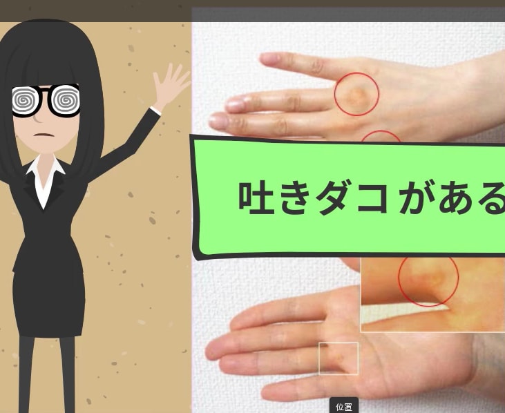 吐きダコができてた芸能人10選